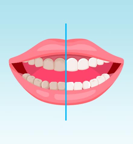 Smile-designing-and-correction