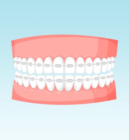 Braces_and_aligners