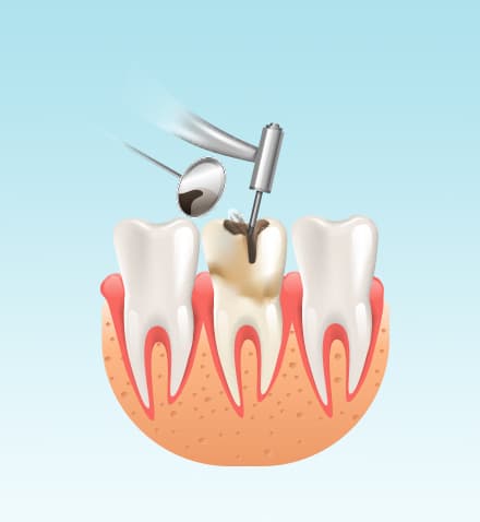 Root_Canal_Treatment