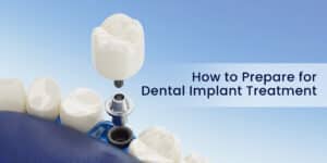 How to Prepare for Dental Implant Treatment 